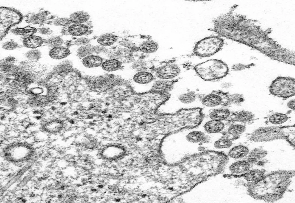 Doi angajați ai Primăriei Ozun, diagnosticați cu COVID-19!
