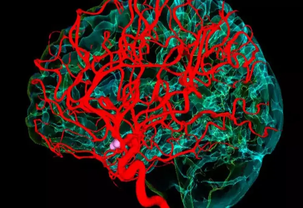 Accident Vascular Cerebral. Cum te recuperezi după un AVC. Ce simptome post-AVC poți avea
